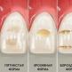 Восстановление зубной эмали в домашних условиях