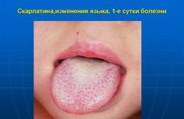 Обложен язык белым налетом: симптомы, причины и лечение
